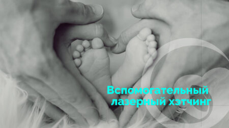 Лазерный Хетчинг